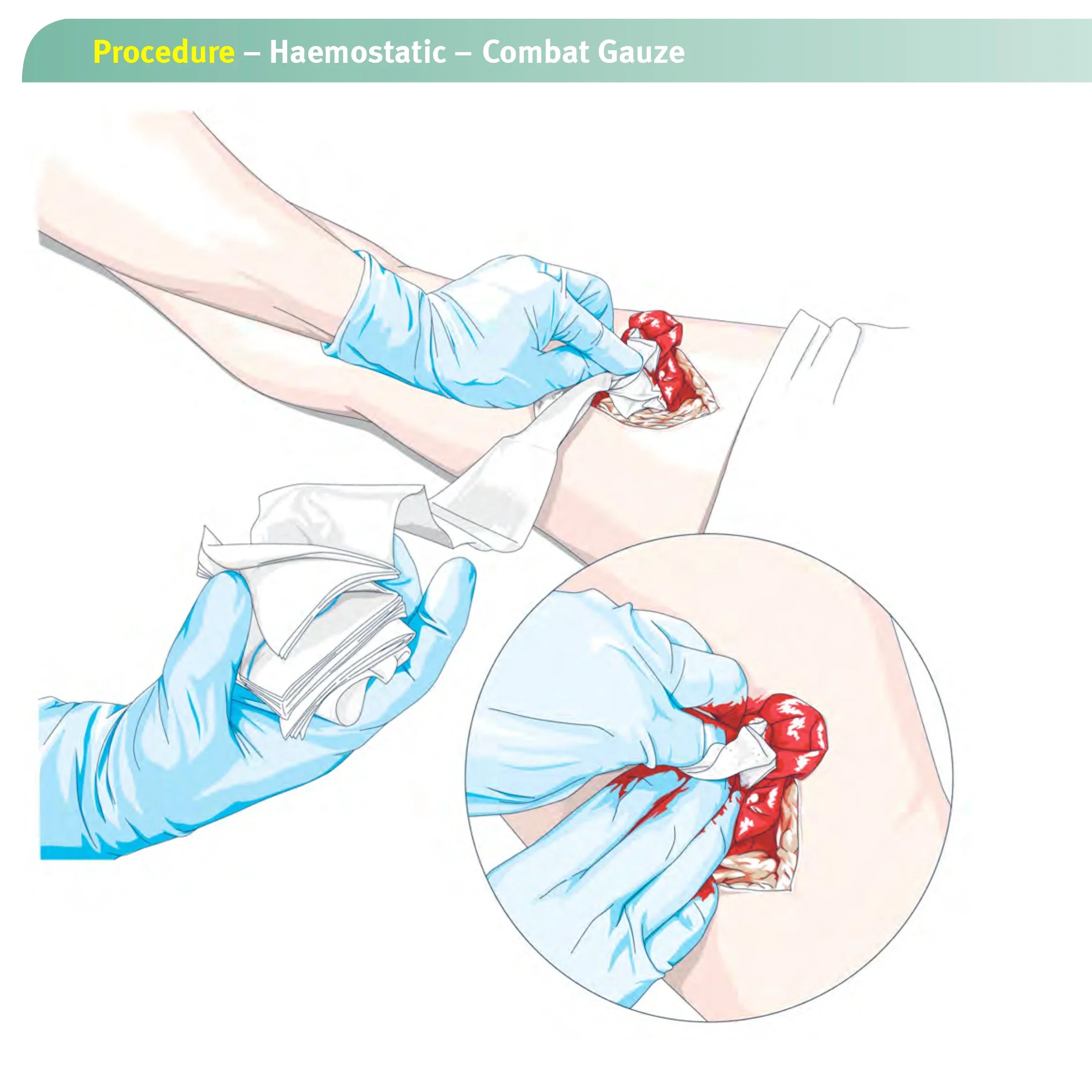 1.5/3.75M Hemostatic Kaolin Gauze Combat Emergency Trauma Z-Fold Soluble For Ifak Tactical  First Aid Kit Medical Wound Dressing